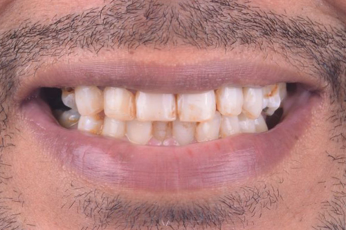 bad teeth