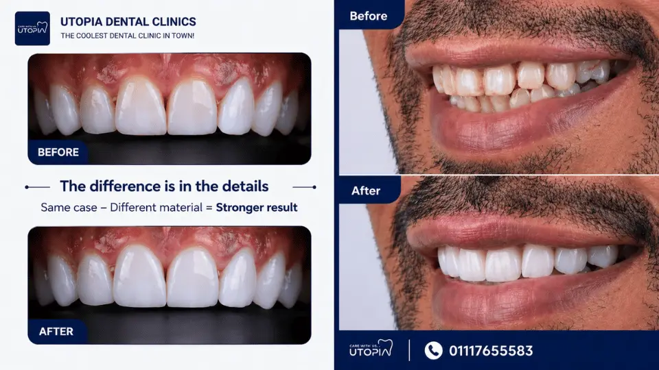 dental veneers