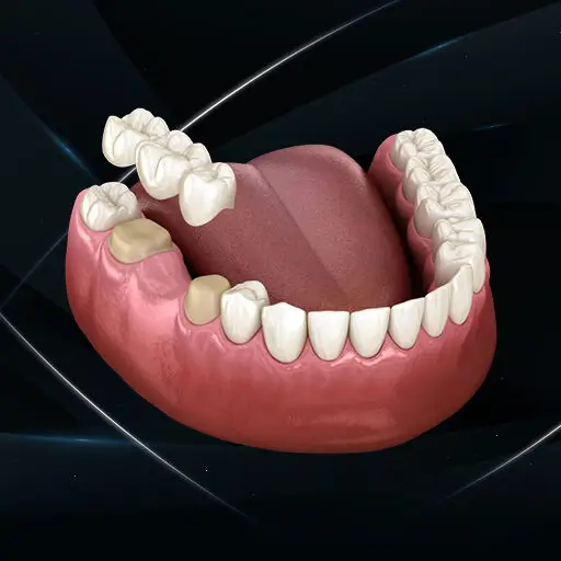 fixed dental Prosthesis