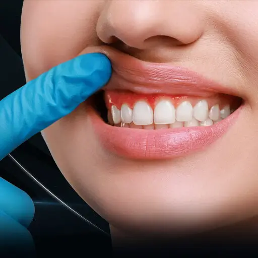 Gingivitis Treatment