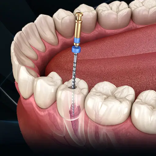 Root Canal Treatment