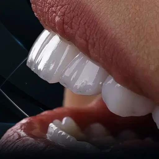 dental veneers