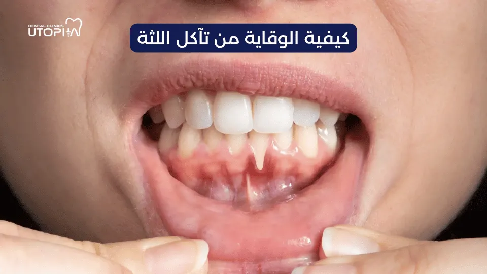 اسباب تاكل اللثة وعلاجها