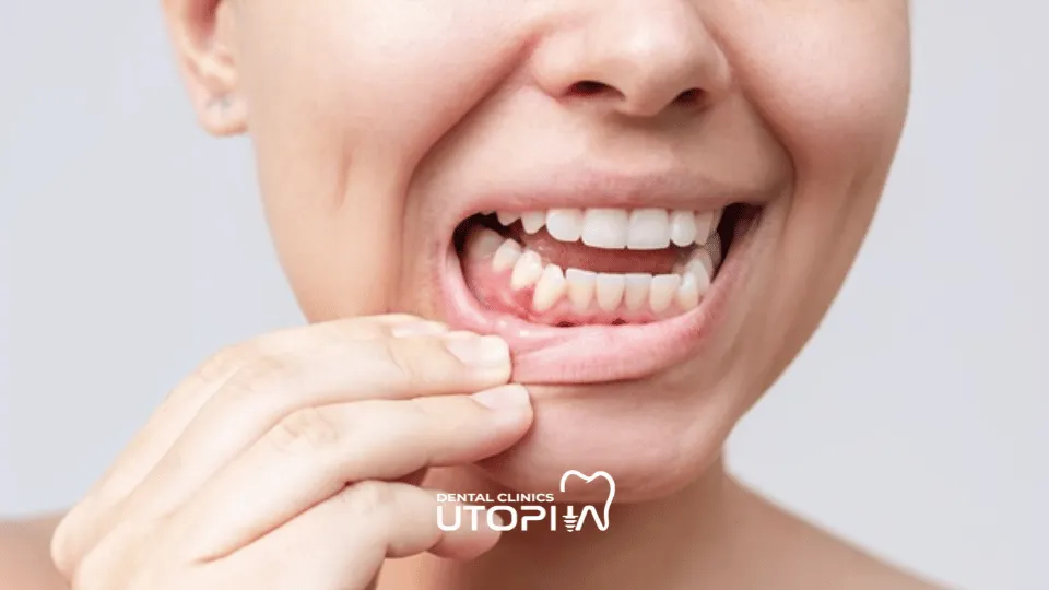 Causes of Gingivitis
