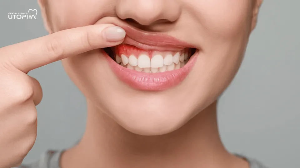 How Long Does It Take To Treat Gingivitis