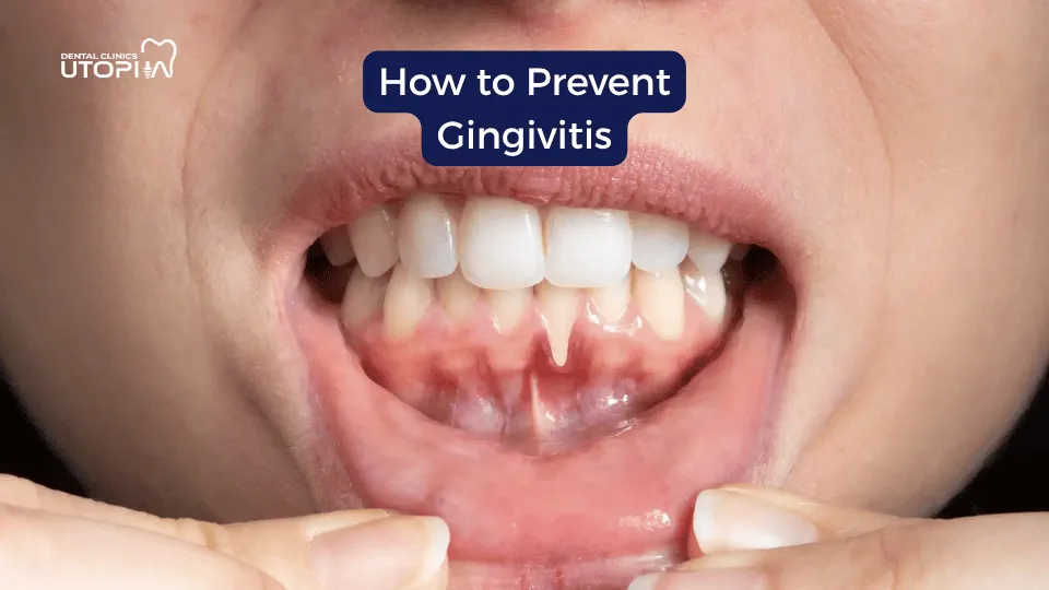 Causes of Gingivitis Causes of Gingivitis