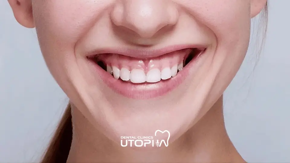 Gummy Smile Treatment Price