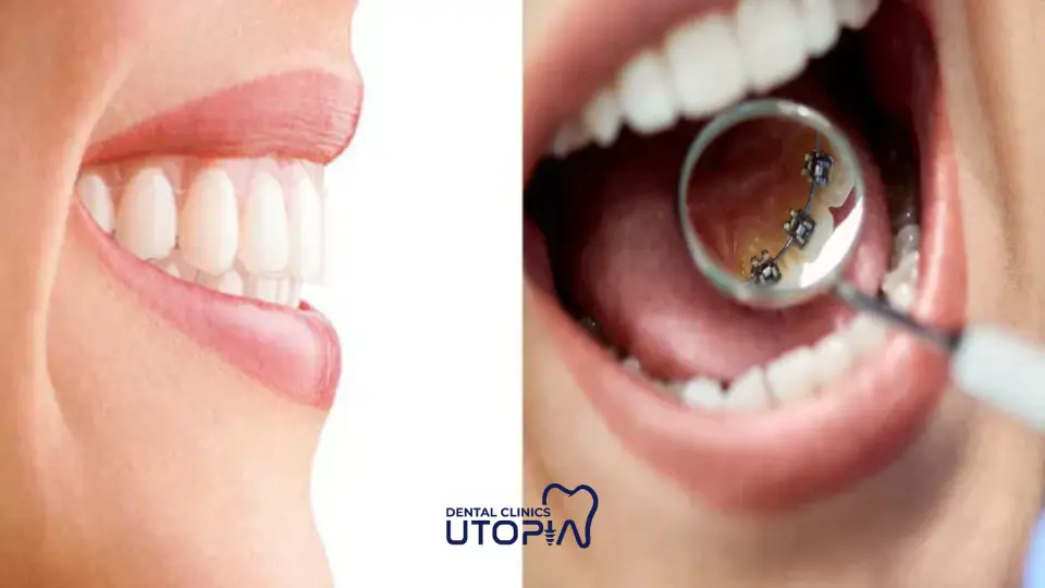 How Long Do Lingual Braces Take To Work How Long Do Lingual Braces Take To Work