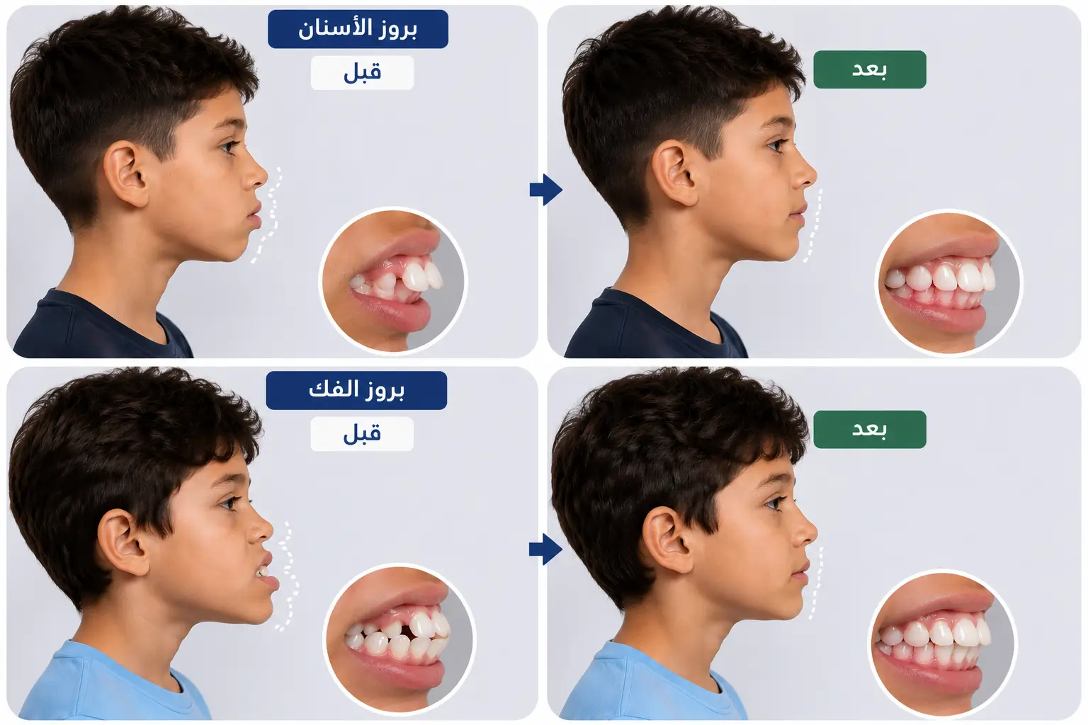 الفرق بين بروز الفك وبروز الاسنان