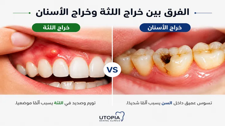 الفرق بين خراج اللثة خراج الأسنان