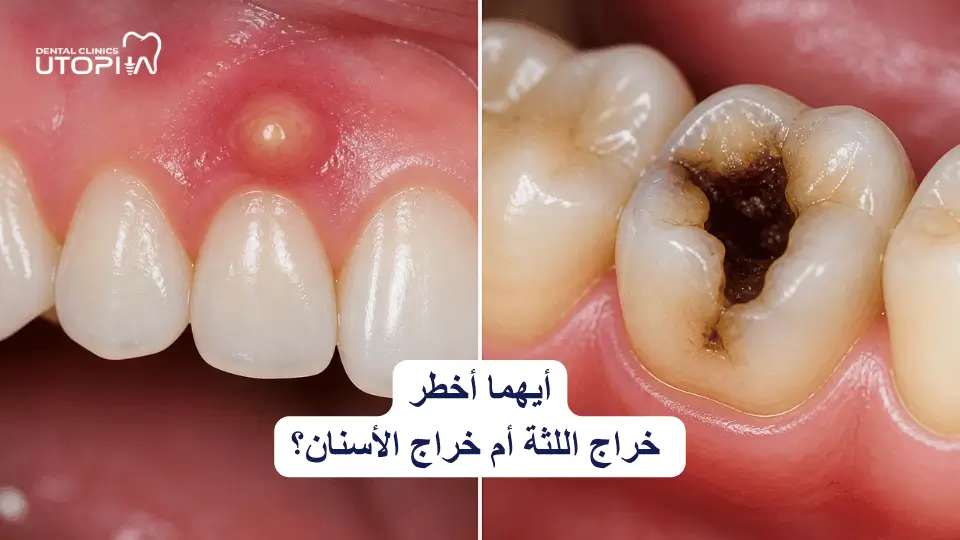الفرق بين خراج اللثة خراج الأسنان