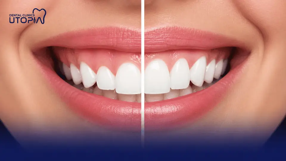 What is Gum Contouring What is Gum Contouring