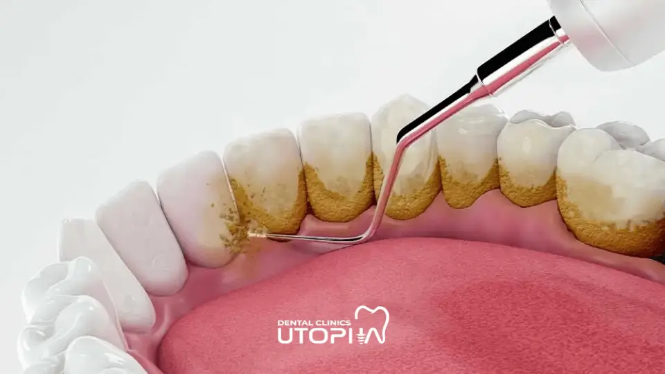 Does Dental Cleaning Damage Teeth