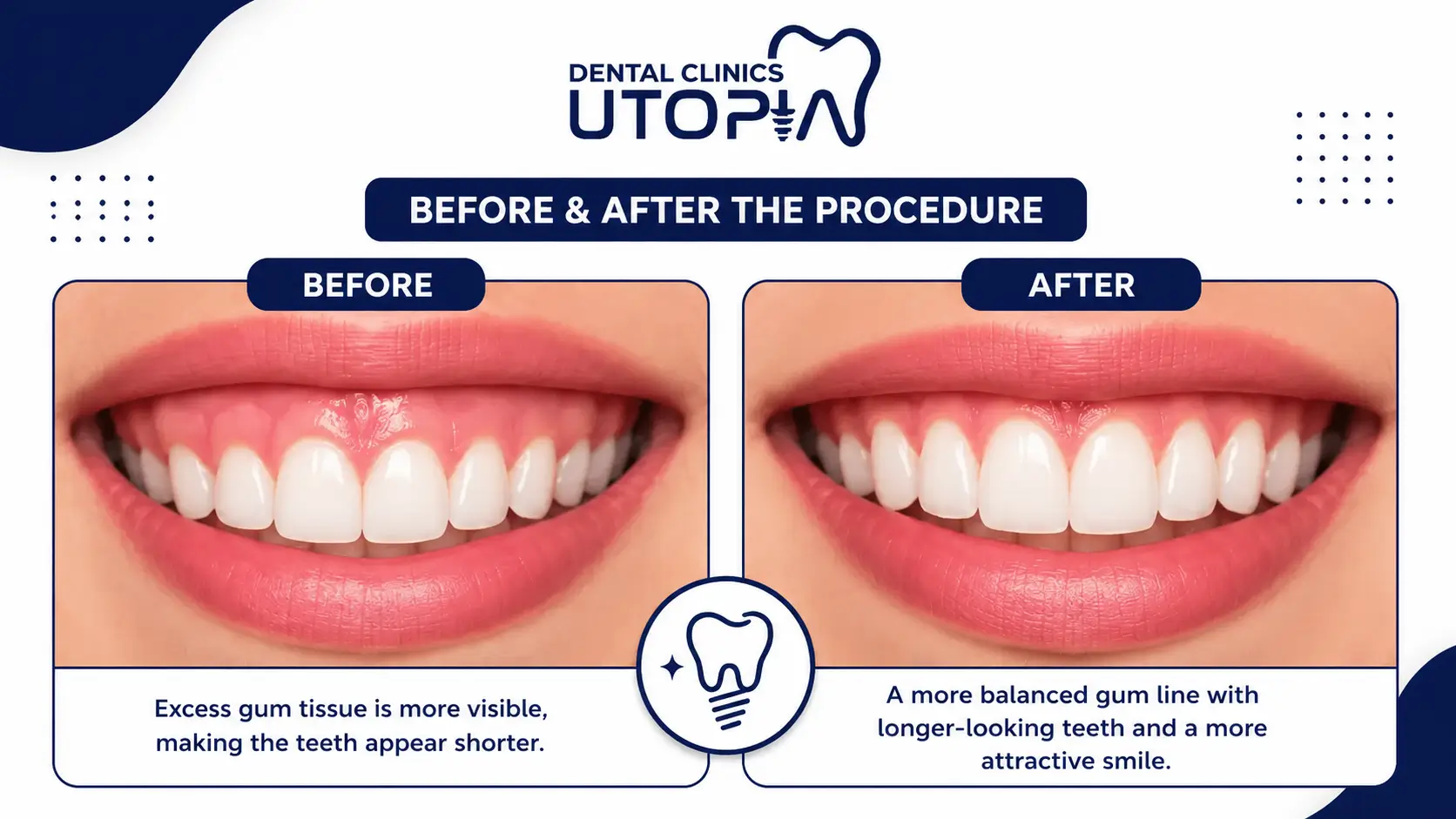 Gingivectomy Before and After