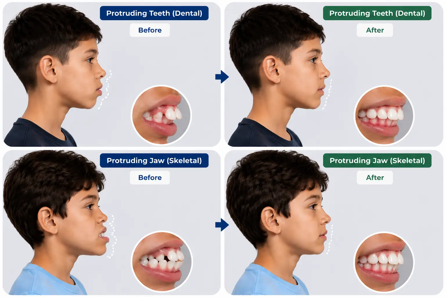 Skeletal vs Dental Malocclusion