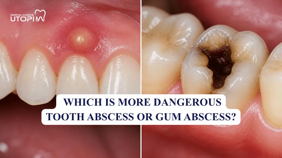 Tooth Abscess and Gum Abscess Tooth Abscess and Gum Abscess