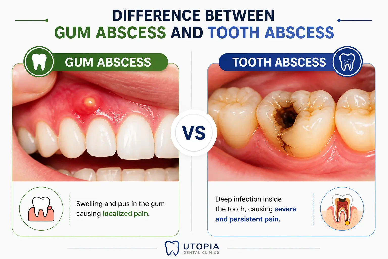 tooth abscess and gum abscess tooth abscess and gum abscess