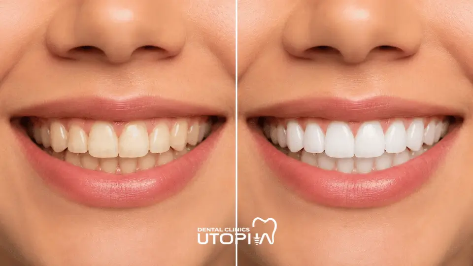 Teeth Whitening vs Polishing
