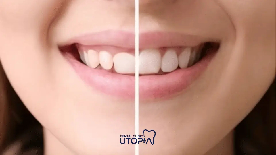 What is Gum Contouring