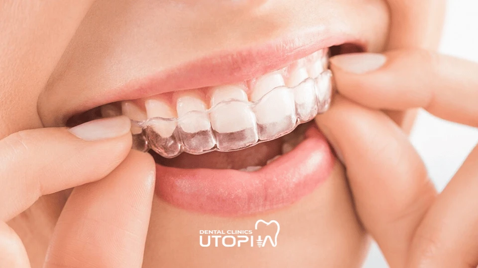 Pros and Cons of Clear Aligners