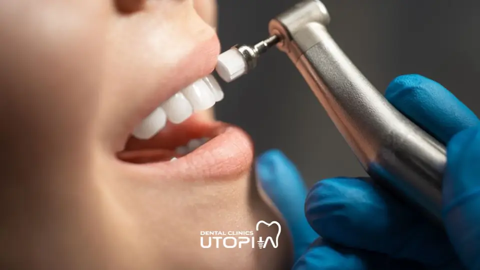 Does Dental Cleaning Damage Teeth